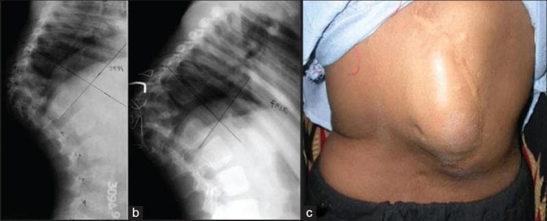 This composite educational image illustrates the progression and external manifestation of severe spinal kyphosis. (a) Lateral radiograph of the dorsolumbar spine showing acute angular kyphosis resulting from childhood spinal tuberculosis (Pott's disease). There is complete destruction of vertebral bodies D9 through D11 with significant loss of height and anterior column collapse. (b) A follow-up lateral radiograph 2.5 years later demonstrates progression of the kyphotic deformity despite posterior spinal fusion, highlighting the risks of exponential growth of the deformity in pediatric patients. (c) A clinical photograph of the patient’s back showing a prominent, sharp angular gibbus deformity in the thoracolumbar region. A midline surgical scar from a previous posterior fusion procedure is visible over the apex of the deformity. The image set demonstrates the clinical-radiological correlation of post-tubercular spinal destruction and the long-term orthopedic challenge of managing spinal stability during growth.