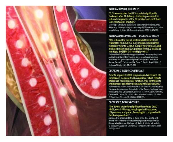 This medical illustration demonstrates the mechanism of action of the Stretta procedure, a minimally invasive treatment for gastroesophageal reflux disease (GERD). The visual depicts a cross-section of the esophageal wall near the gastroesophageal junction. Key components include multiple nickel-titanium needle electrodes delivering radiofrequency (RF) energy into the muscularis propria of the esophagus, represented by bright yellow circular glows within the red-textured tissue layers. The anatomical focus is on the lower esophageal sphincter (LES) region. Accompanying text panels summarize clinical outcomes and pathophysiology: increased wall thickness, increased LES basal pressure with decreased transient LES relaxations (TLESRs), decreased tissue compliance at the gastroesophageal junction, and significantly decreased esophageal acid exposure. The image highlights the device's ability to deliver thermal energy to induce tissue remodeling while protecting the overlying mucosa via irrigation. This illustration serves as an educational tool for gastroenterologists and surgical trainees to understand non-surgical antireflux interventions and their physiological impact on LES neuromuscular function.