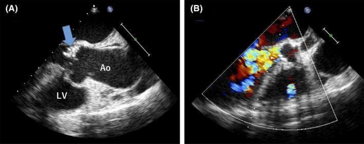 Diagnostic ultrasound imaging featuring transesophageal echocardiography (TEE) for the assessment of infective endocarditis. Panel A displays a grayscale long-axis view of the left ventricle (LV) and aorta (Ao). A blue arrow identifies a prominent, hyperechoic, and motile vegetation measuring approximately 1.5 cm localized on the noncoronary cusp of the aortic valve. Panel B shows the same view with Color Doppler application, demonstrating high-velocity, mosaic, and turbulent retrograde flow from the aorta into the left ventricle, indicating severe aortic regurgitation. The imaging illustrates the cardiac manifestations of systemic infection, highlighting the correlation between valvular vegetations and resultant hemodynamic dysfunction. This visual is intended for medical education regarding the diagnostic criteria for Duke's definitive infective endocarditis and the assessment of valvular pathology.
