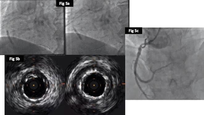 This composite figure illustrates a percutaneous coronary intervention (PCI) procedure for in-stent restenosis (ISR). Panel 5a consists of two fluoroscopic frames showing balloon angioplasty (POBA) being performed to optimize a previously deployed stent in the Right Coronary Artery (RCA); a radiopaque balloon catheter is visible within the vessel lumen. Panel 5b presents cross-sectional Intravascular Ultrasound (IVUS) images, showing a circular, widely patent lumen with improved stent expansion and wall apposition following the intervention. The bright, circumferential echoes represent the expanded stent struts against the vessel wall. Panel 5c displays the final coronary angiogram, revealing an excellent procedural result with a smooth, unobstructed lumen in the RCA and successful restoration of distal blood flow without signs of residual stenosis or dissection. This sequence demonstrates the use of intravascular imaging to guide and verify successful balloon optimization in complex coronary revascularization cases.