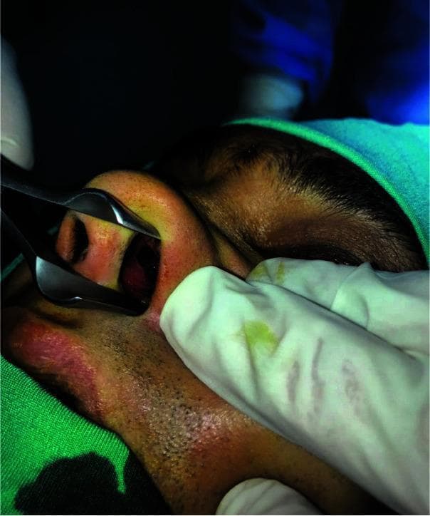 This intraoperative clinical photograph captures a preoperative nasal examination in a surgical setting. The image demonstrates the use of a metallic nasal speculum, with its blades spread to retract the right ala and dilate the nostril, providing visualization of the internal nasal anatomy. The focus is on the anterior nasal cavity, specifically intended for assessing a nasal septal perforation (NSP). The patient is draped in a sterile field with a green surgical cap visible. A clinician’s gloved hand is seen stabilizing the nasal area. The skin of the nose and cheek shows mild erythema and irritation. This visual is used in otorhinolaryngology and maxillofacial surgery to teach the technique of anterior rhinoscopy for diagnosing and measuring septal defects prior to surgical repair, such as a mucosal rotational flap procedure.