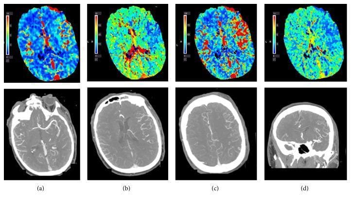 This composite diagnostic image illustrates cerebral hyperperfusion in a 61-year-old patient following intravenous thrombolysis (tPA). The top row consists of four axial Computed Tomography Perfusion (CTP) maps. Subfigure (a) Cerebral Blood Volume (CBV) and (c) Cerebral Blood Flow (CBF) demonstrate increased values in the left middle cerebral artery (MCA) territory, visualized as prominent warm red/orange areas compared to the contralateral side. Subfigure (b) Time to Peak (TTP) and (d) Mean Transit Time (MTT) maps show corresponding areas of shortened transit times, indicated by cooler blue/green hues. The bottom row presents CT Angiogram (CTA) images in axial (a-c) and coronal (d) planes. These images show a distinct dilation of the left MCA and its cortical branches compared to the right side, with marked contrast enhancement. This combination of findings—increased CBF/CBV and shortened transit times alongside arterial dilation—is indicative of post-ischemic hyperperfusion syndrome or reactive hyperemia in the context of acute stroke management. The images are highly relevant for neuroradiology education focusing on vascular imaging and perfusion parameters after reperfusion therapy.