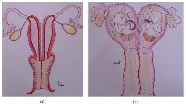 This anatomical schematic diagram illustrates uterus didelphys, a Müllerian duct anomaly, in two states. Image (a) depicts a nongravid (non-pregnant) uterus didelphys, showing two completely separate uterine horns and two distinct cervices. The illustration also shows accompanying fallopian tubes and ovaries. Image (b) presents a gravid (pregnant) uterus didelphys with a dicavitary twin pregnancy. In this state, each independent uterine cavity contains a developing fetus in a cephalic presentation, along with its own placenta and umbilical cord. This comparison highlights the structural duplication of the reproductive tract and the rare clinical scenario of simultaneous gestation in both separate cavities. The diagram is designed for educational use in obstetrics and gynecology to explain congenital uterine malformations and their implications for multifetal pregnancy.