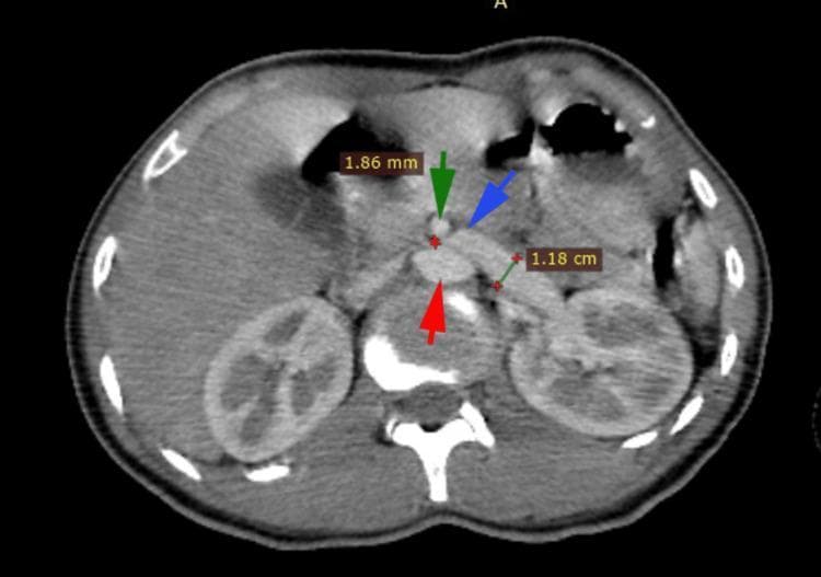 This diagnostic image is an axial contrast-enhanced abdominal CT scan demonstrating the anatomical hallmarks of Nutcracker Syndrome (renal vein entrapment). The image highlights the critical relationship between major abdominal vessels. An abdominal aorta (indicated by a red arrow) is positioned posteriorly. Anterior to it, the superior mesenteric artery (SMA, indicated by a green arrow) is shown with a measured diameter of 1.86 mm. The left renal vein (LRV, indicated by a blue arrow) is visibly compressed as it passes through the narrow angle between the SMA and the aorta. A distal segment of the left renal vein is measured at 1.18 cm, illustrating pre-stenotic dilatation or engorgement compared to the compressed segment. The visual evidence of this vascular arrangement explains the extrinsic compression of the LRV, which clinically often manifests as hematuria and pelvic congestion. The scan also captures cross-sections of both kidneys and the vertebral column, providing clear orientation for the retroperitoneal structures involved.