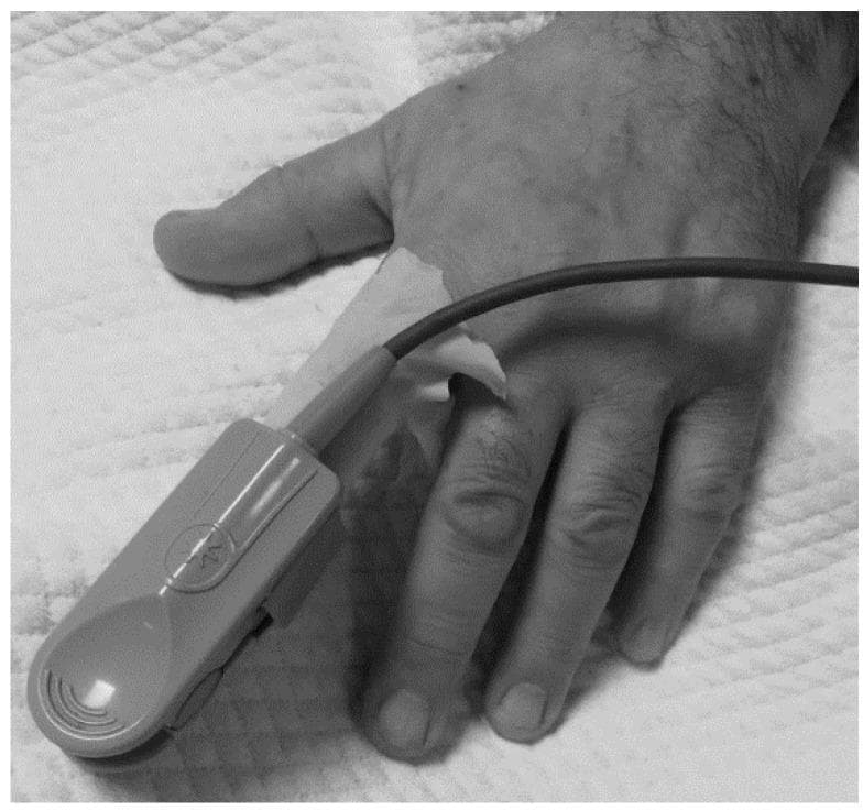 A clinical photograph in grayscale showing a pulse oximeter probe applied to a patient's index finger over a white glove. The hand is resting on a textured medical surface. The pulse oximeter is a spring-loaded clip-on device, connected via a cable to an external monitor. This procedural image demonstrates a clinical experimental setup used to evaluate the effect of glove material on oxygen saturation (SpO2) measurement accuracy. The visible portion of the hand shows normal skin texture and nail anatomy on the adjacent uncovered fingers. The educational focus is on medical instrumentation, patient monitoring, and the potential interference of external barriers, such as gloves, with non-invasive diagnostic tools. The setup represents a study of how light source transmission in pulse oximetry is impacted by synthetic materials in a clinical or perioperative setting.