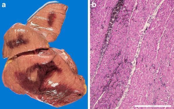 This dual-panel image demonstrates macroscopic and microscopic pathology of acute myocardial infarction with hemorrhagic components. Panel (a) is a clinical photograph of tangential slices from an unfixed human heart, specifically the posterior wall of the left ventricle. It reveals large, irregularly shaped, dark red-to-purple hemorrhagic areas measuring approximately 4 cm x 3 cm and 5 cm x 7 cm, contrasting sharply against the lighter tan-colored myocardium. Panel (b) shows a corresponding histological section stained with Hematoxylin and Eosin (H&E) at 4x magnification. The micrograph depicts eosinophilic (pink) cardiomyocytes with visible structural disruption, including areas of contraction band necrosis and loss of nuclei. Notable pathological features include a prominent longitudinal band of hemorrhage and leukocyte infiltration, which serves to demarcate the necrotic zone from vital muscle. These findings are characteristic of hemorrhagic myocardial infarction and suggest an acute ischemic event followed by vascular rupture or reperfusion injury. The image is intended for medical education in cardiology and pathology to illustrate gross and microscopic signs of myocardial death.