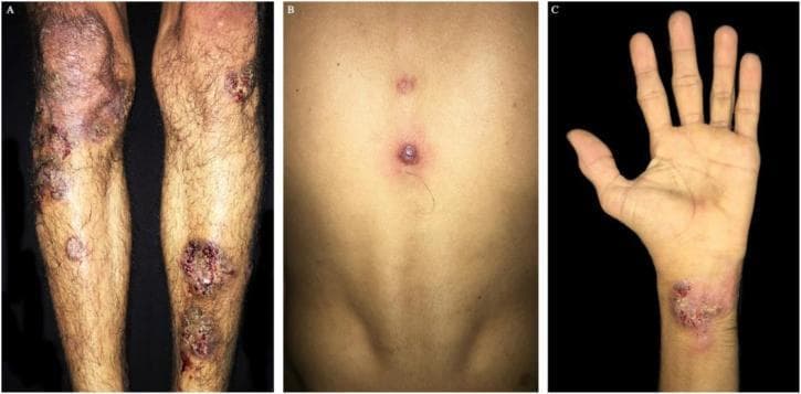 Clinical photograph series showing cutaneous manifestations of pyoderma gangrenosum. Image A displays the lower limbs with multiple erythematous nodules and deep ulcers. These lesions feature well-defined, slightly raised, violet-brownish borders and a characteristic cribriform (sieve-like) appearance in the ulcer bed, accompanied by perilesional erythema. Image B focuses on the dorsal trunk, presenting a violet papule with central vesiculation and two smaller satellite papules. Image C shows a similar ulcerated plaque on the volar aspect of the wrist/hand. The morphology is consistent with neutrophilic dermatosis often associated with systemic conditions or vasculitis. Educational focus includes the recognition of undermined borders and cribriform scarring typical of pyoderma gangrenosum. These clinical findings are relevant for dermatology and internal medicine, particularly in the context of identifying diagnostic cutaneous markers for underlying systemic inflammatory or toxicological causes.