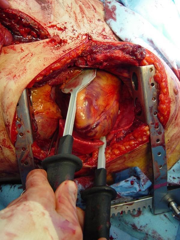 This clinical photograph captures a critical surgical moment during emergency resuscitative thoracotomy. The image shows an open chest cavity with a metal rib retractor in place, providing wide exposure of the mediastinum and the heart. The heart appears mottled with reddish-purple and yellow tones, suggestive of physiological stress or trauma. Two internal defibrillation paddles are actively being used; they feature spoon-shaped, white metallic surfaces with black insulated handles. One paddle is positioned on the anterior surface of the heart while the other is placed posteriorly, 'sandwiching' the myocardium to deliver a direct electrical shock for cardioversion or defibrillation. Significant hemorrhage is visible within the surgical field and on the surrounding drapes, reflecting the acute trauma setting. This visual serves as a primary educational tool for demonstrating the technique of internal cardiac massage and the correct placement of internal paddles in advanced trauma life support and thoracic surgery.