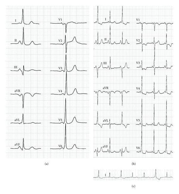 This composite diagnostic image displays surface electrocardiograms (ECGs) from a patient with ventricular pre-excitation. Panel (a) shows a standard 12-lead ECG characterized by a shortened PR interval, the presence of a delta wave (slurring of the initial QRS upstroke), and widened QRS complexes, which are classic signs of Wolff-Parkinson-White (WPW) syndrome pattern. Panel (b) presents another 12-lead strip showing beat-to-beat variability: the first and third beats exhibit pre-excitation (short PR, delta wave, wide QRS), while the second beat displays a normal PR interval and narrow QRS morphology. Panel (c) provides a continuous Lead I rhythm strip illustrating this electrical alternation (alternance), where pre-excited beats alternate with normally conducted beats. The ECG findings are essential for identifying accessory pathway conduction and evaluating the results of catheter ablation procedures. Clinically, the alternation in Panel (b) and (c) can represent intermittent pre-excitation or fusion beats between normal atrioventricular conduction and an ectopic ventricular rhythm arising near a previous ablation site.
