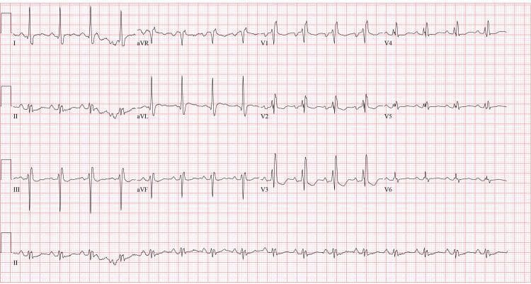 A 12-lead electrocardiogram (ECG) displayed in a standard 4x3 layout with a rhythm strip (Lead II) at the bottom. The tracing exhibits a regular normal sinus rhythm with consistent P-wave morphology preceding each QRS complex. Significant conduction abnormalities are present, most notably a widened QRS duration (>120 ms) with a classic RSR' pattern (rsR') in the right precordial leads V1-V3 and broad, slurred S-waves in the lateral leads (I, aVL, V5-V6), characteristic of a right bundle branch block (RBBB). Additionally, the ECG demonstrates nonspecific ST-segment and T-wave abnormalities, including mild ST-segment depression and T-wave inversions/flattening across various leads. The PR interval appears within normal limits. This diagnostic image serves as an educational example of intraventricular conduction delay and secondary repolarization changes in the context of clinical cardiovascular evaluation.