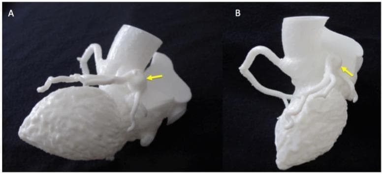 Clinical photograph of a 3D-printed anatomical heart model used for pediatric cardiology education, specifically demonstrating sequelae of Kawasaki Disease. The image features two perspectives (A and B) of a white, monolithic resin model. Both views highlight a significant coronary artery aneurysm (CAA), indicated by yellow arrows. View A provides a superior-lateral perspective, showing the aneurysm as a large, spherical outpouching located on a major coronary vessel near the base of the ascending aorta. View B provides a rotated posterior-lateral perspective, illustrating the aneurysm's spatial relationship to other distal coronary branches and the ventricular surface. The model effectively captures the tortuosity and abnormal vessel morphology associated with systemic vasculitis. This visual serves as an educational tool for medical professionals to study the three-dimensional geometry of cardiac vascular anomalies and plan potential interventions for patients with Kawasaki-induced cardiovascular complications.