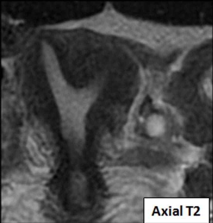 This diagnostic image is an axial T2-weighted MRI slice of the female pelvis focusing on the uterus. It demonstrates a bicornuate unicervical uterus, a congenital Mullerian duct anomaly. The image shows a single cervix and inferior uterine segment that bifurcates superiorly into two distinct, divergent uterine horns. The T2-weighted sequence provides high contrast between the hyperintense (bright) endometrial lining and the relatively hypointense (darker) myometrium. The deep fundal cleft between the two horns confirms the bicornuate morphology rather than a septate uterus. This imaging is characteristic of Class IV Mullerian duct anomalies and is clinically significant in evaluations for infertility or obstetric complications. The surrounding pelvic anatomy, including the bladder and adjacent soft tissues, is visible with varying signal intensities reflecting tissue water content.