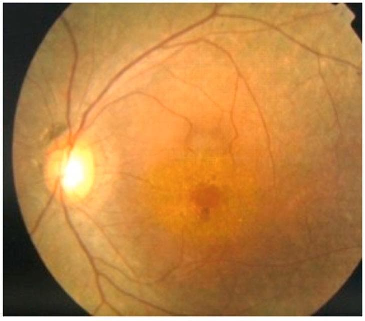 This clinical photograph displays a fundus view of the retina, identifying key diagnostic features associated with retinitis pigmentosa in a patient with Mucopolysaccharidosis Type II (MPS II or Hunter Syndrome). The image shows a well-defined optic disc with clear margins. The retinal vasculature exhibits significant attenuation, with thinning of both the arterioles and venules as they radiate toward the periphery. Centrally, the macula demonstrates a pigmented lesion and areas of atrophy, indicating macular involvement. The background retina reveals uneven pigmentation with a granular appearance, characteristic of tapetoretinal degeneration. These visual findings provide clinical evidence of retinopathy, which is a significant posterior chamber manifestation of MPS II, leading to nyctalopia and progressive visual field loss. The imaging is essential for ophthalmologists monitoring metabolic disorders where glycosaminoglycan (GAG) deposition can impact ocular structures.