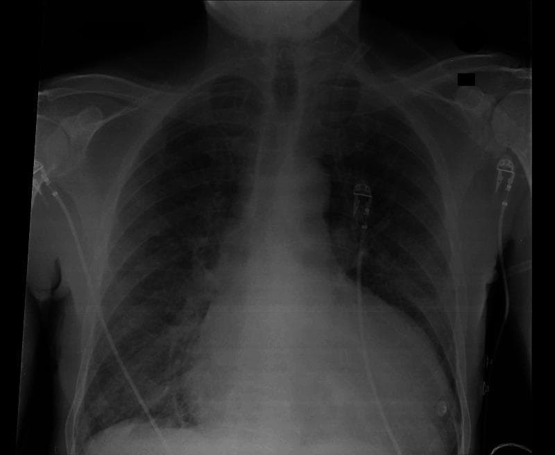 This diagnostic image is a posterior-anterior (PA) view chest radiograph. The primary anatomical findings include significant cardiomegaly, evidenced by an increased cardiothoracic ratio with a widened heart silhouette and lateral displacement of the left heart border. Both lung fields demonstrate diffuse, bilateral pulmonary infiltrates, characterized by hazy, increased opacification that obscures normal vascular markings. These findings are clinically suggestive of pulmonary edema and congestive heart failure. Additionally, visible medical artifacts include external monitoring leads and cables overlying the thoracic cage and axillary regions. The trachea is midline, and the visualized bony structures, including the clavicles and ribs, appear intact. This radiograph serves as a key educational example of cardiogenic pulmonary congestion in the context of cardiovascular pathology, such as syphilitic aortitis or aortic root aneurysm leading to heart failure.