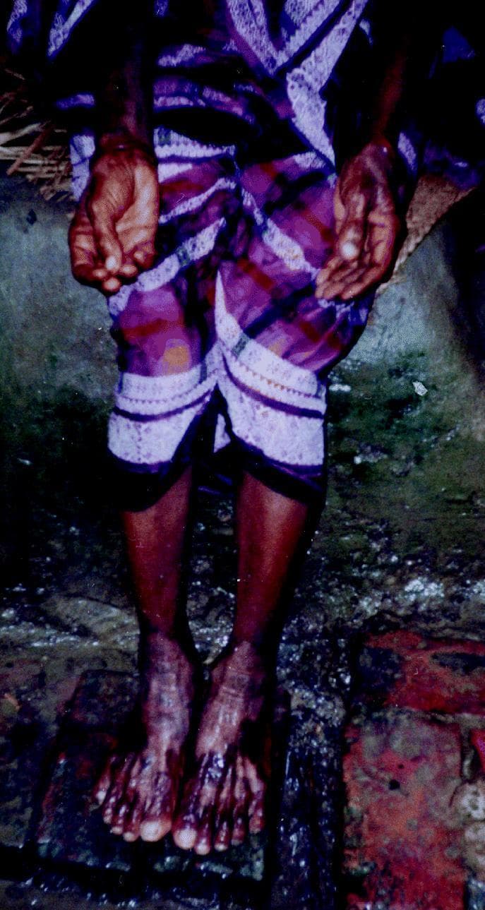 This clinical photograph illustrates the dermatological and vascular manifestations of chronic arsenic poisoning in a patient. The image displays the hands and feet of a female, highlighting two hallmark conditions: palmar keratosis and 'blackfoot disease.' The palmar surfaces of the hands show significant hyperkeratosis, characterized by thickened, roughened skin with exaggerated creases and hyperpigmentation. The feet and lower legs demonstrate advanced peripheral vascular changes. Specifically, the toes and distal portions of the feet exhibit severe dark discoloration ranging from deep mahogany to black, indicative of gangrenous changes or severe ischemia associated with blackfoot disease. The skin in these affected areas appears shiny or atrophic. This presentation is characteristic of long-term exposure to high levels of arsenic in drinking water, which leads to multisystemic toxicity, including hyperkeratosis and obliterative angiopathy. The photograph serves as an educational tool for identifying systemic signs of environmental toxicant exposure in endemic regions.