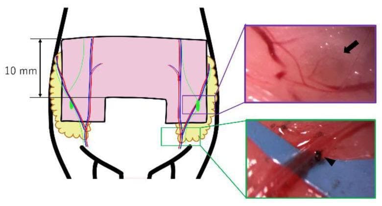 This medical illustration and surgical photograph composite details a murine model flap design for researching vascularized lymph node transfer (VLNT). The primary diagram shows a 10 mm wide bilateral pedicled abdominal flap (pink U-shaped skin paddle) that incorporates subcutaneous fat (yellow) and inguinal lymph nodes (green ovals). The vascular anatomy is depicted with abdominal arteries (red) and veins (blue). A purple inset provides a high-magnification view identifying a left groin lymph node (black arrow) and its associated feeding vessels. A green inset demonstrates the surgical technique for creating a unilateral congestion model through venous ligation; a black arrowhead indicates the specific ligation point on the vein, performed with a 10-0 nylon suture. This model is used to simulate clinical scenarios of impaired blood flow in transferred lymph nodes, allowing for the comparative study of ischemic, congestive, and control flap survival rates and pathological changes.
