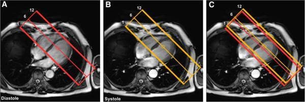 Diagnostic Cardiac MRI (CMR) acquisition planning diagram for 3D myocardial perfusion imaging. The image displays three axial 4-chamber cine frames (Panels A, B, and C) used to coordinate slice positioning during different phases of the cardiac cycle. In Panel A (Diastole), a red rectangular volume stack containing 12 slices is positioned over the heart, with markers for slices 1, 6, and 12 indicating coverage from the atria toward the ventricular apex. Panel B (Systole) demonstrates a yellow rectangular volume stack planned on the end-systolic frame. Panel C shows both the red (diastolic) and yellow (systolic) stacks superimposed on a single systolic frame, highlighting the longitudinal displacement and lengthening of the heart. This visualizes the necessity of phase-specific planning to account for cardiac motion, ensuring accurate quantification of myocardial blood flow (MBF) and myocardial perfusion reserve (MPR) in patients with suspected coronary artery disease (CAD). The images represent key technical steps in 3D-perfusion CMR protocols for medical students and radiology residents specializing in cardiovascular imaging.