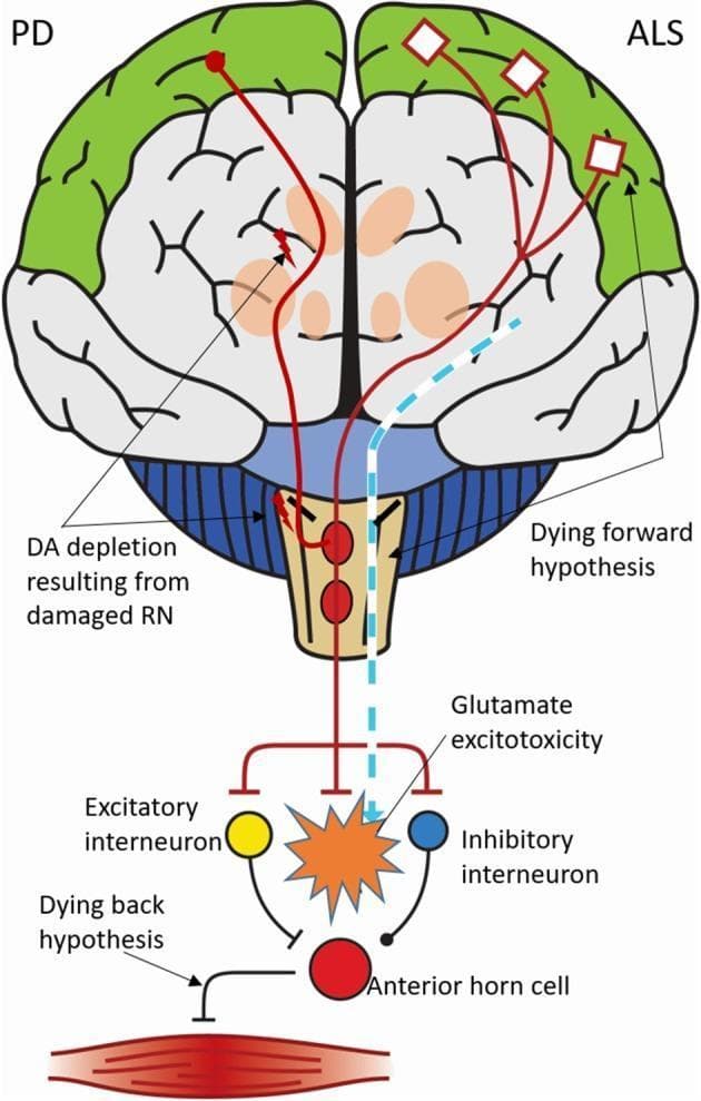 This pathophysiology diagram illustrates the dysfunctional serotonergic pathways in Parkinson's disease (PD) and Amyotrophic Lateral Sclerosis (ALS). The upper section compares cerebral mechanisms: the PD side depicts lesioned raphe nuclei (RN) and dopamine (DA) depletion leading to decreased motor cortex activity. The ALS side shows cortical involvement with projections descending toward the brainstem. The lower section detail spinal cord mechanisms, focusing on the motor neuron. It contrasts two disease progression theories: the 'Dying Forward Hypothesis,' represented by descending pathways leading to glutamate excitotoxicity and anterior horn cell degeneration; and the 'Dying Back Hypothesis,' showing retrograde pathology originating from the muscle or neuromuscular junction towards the anterior horn cell. Key components include the motor cortex (green), anterior horn cell (red circle), muscle fiber, and regulatory interneurons (excitatory and inhibitory). The diagram highlights how serotonergic loss facilitates glutamatergic excitotoxicity in ALS versus dopaminergic-serotonergic interactions in the basal ganglia of PD patients, emphasizing different anatomical sites of primary neurodegeneration.