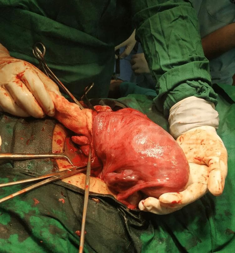 This clinical photograph captures an intraoperative view during an emergency Lower Segment Cesarean Section (LSCS), demonstrating a unicornuate uterus. The uterus is notably tubular and elongated, exhibiting a characteristic 'banana-shaped' morphology associated with Müllerian duct anomalies. The uterine surface appears erythematous and highly vascularized, typical of gestational changes. The surgical field is established with green sterile drapes, and the uterus is being exteriorized and supported by a surgeon wearing blood-stained sterile gloves. Surgical instruments, including forceps and retractors, are visible within the abdominal incision. This image serves as a significant educational example of a Class II Müllerian duct anomaly (AFS classification), highlighting the anatomical variations encountered during obstetric surgery in patients with congenital uterine malformations.