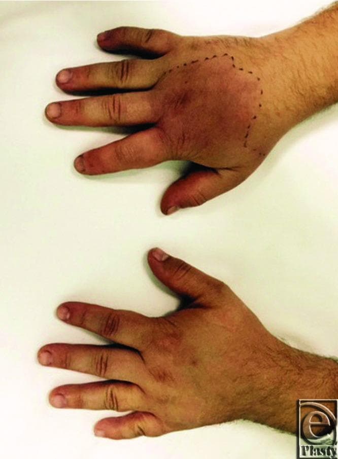 A clinical photograph showing a comparative dorsal view of two human hands. The top hand exhibits clinical signs of cellulitis or acute inflammation, characterized by diffuse swelling (edema) across the dorsum and extending into the digits, accompanied by confluent erythema. A black dotted ink line has been marked on the skin at the proximal aspect of the wrist to demarcate the advancing border of the erythema and monitor clinical progression. The digits on the affected hand appear significantly more bulbous compared to the bottom hand, which serves as a healthy control with normal anatomical contours and skin pigmentation. This image demonstrates the visual presentation of rapidly spreading soft tissue infection or a severe inflammatory response, highlighting the diagnostic importance of physical examination findings such as unilateral swelling, redness, and the use of clinical marking for progression tracking.