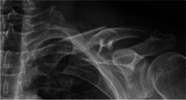 This diagnostic X-ray captures a comminuted fracture of the left clavicle, specifically involving the midshaft or middle third of the bone. The fracture exhibits significant displacement and angulation of the primary medial and lateral bone segments. Multiple smaller fracture fragments are visible at the fracture site, characterizing the injury as comminuted (Robinson classification type 2B2). The superior displacement of the medial fragment is evident, while a notable gap exists between the main segments. Adjacent visible anatomy includes the acromion process of the scapula forming the acromioclavicular joint, the glenohumeral joint with the proximal humerus, the upper rib cage, and the cervical spine vertebrae. No acute abnormalities are seen in the humeral head or the visible portions of the ribs. This image is a primary educational example of orthopedic trauma, illustrating a high-energy clavicular injury and the resulting loss of anatomical alignment often associated with potential neurovascular compression or skin tenting.
