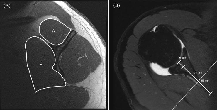 This dual-panel diagnostic image demonstrates a standardized methodology for measuring the cross-sectional area (CSA) of rotator cuff muscles using Magnetic Resonance Imaging (MRI). The left panel (A) is a sagittal T1-weighted MR-arthrography image taken 31 mm medial to the glenoid cavity. It displays outlined regions for the supraspinatus (labeled 'A') and the subscapularis (labeled 'D'). The supraspinatus appears as a superior, rounded structure, while the subscapularis is larger and more elongated, positioned anteriorly. The right panel (B) is an axial Proton Density (PD)-weighted image showing the medial distance landmarks from the glenoid cavity base used to define specific measurement planes: 6 mm for the teres minor, 31 mm for the supraspinatus and subscapularis (indicated by a white reference line), and 55 mm for the infraspinatus. This protocol is utilized in musculoskeletal radiology to objectively quantify muscle atrophy or hypertrophy in patients with rotator cuff pathology, providing anatomical landmarks for reproducible clinical assessment.