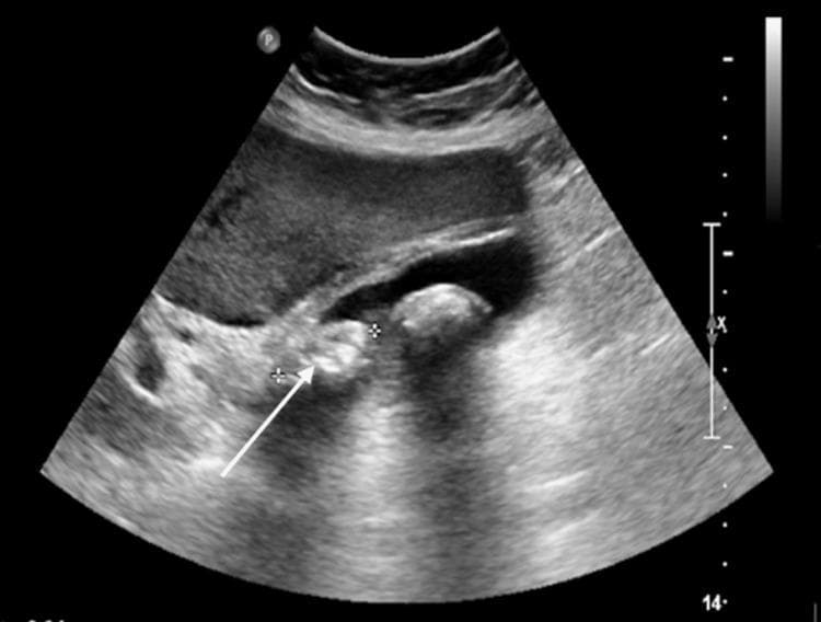 This abdominal ultrasound image displays diagnostic features characteristic of acute cholecystitis. The primary finding is a large, hyperechoic gallstone (indicated by a white arrow) situated within the gallbladder lumen, exhibiting distinct posterior acoustic shadowing. The gallbladder wall is significantly thickened and edematous, appearing as a multi-layered, hypoechoic border around the organ. A thin, anechoic layer of pericholecystic fluid is visible adjacent to the gallbladder wall, further indicating localized inflammation. Clinical correlation provided in the context notes a positive sonographic Murphy's sign, which is an essential bedside diagnostic indicator of gallbladder inflammation. This image is an educational example for radiology and emergency medicine residents to identify the classic triad of gallstones, wall thickening, and pericholecystic fluid in the assessment of right upper quadrant pain.