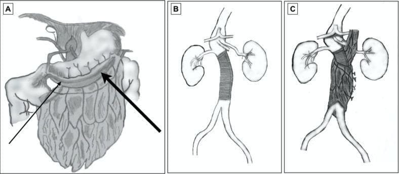 A three-part anatomical diagram (A-C) illustrating the surgical technique of omental wrapping for an abdominal aortic graft. Panel A shows the preparation of the greater omentum, highlighting its vascular supply from the gastroepiploic arteries; a thin arrow indicates the right gastroepiploic artery and a thick arrow indicates the left gastroepiploic artery along the greater curvature of the stomach. Panel B depicts the abdominal aorta following the implantation of a tubular Dacron graft in the infrarenal position, situated between the renal arteries and the iliac bifurcation. Panel C demonstrates the completed procedure where a vascularized pedicle of the greater omentum is circumferentially wrapped around the Dacron graft. This technique is typically used in the management of infected aortic aneurysms or complex reconstructions to provide a viable blood supply, facilitate infection control, and protect the prosthetic material. The diagram serves as an educational tool for vascular surgery, focusing on surgical anatomy and tissue flap transposition.