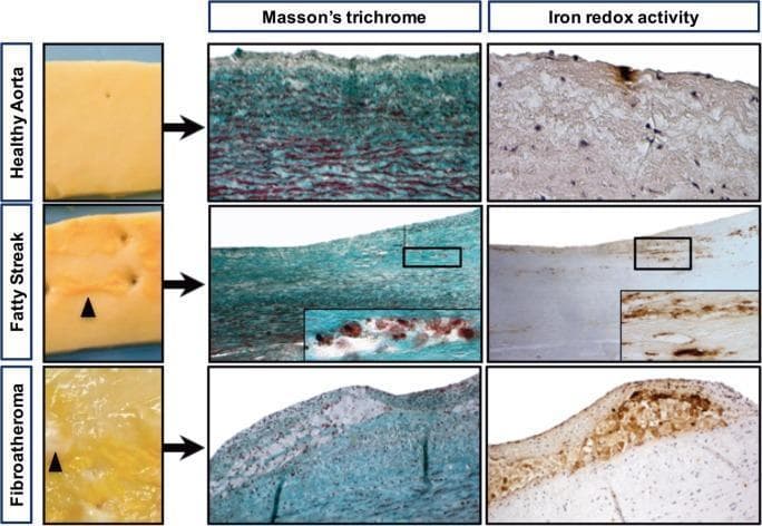 This composite educational graphic illustrates the progression of atherosclerosis in the human aorta through macroscopic photography and histopathology. The content is organized into three rows: Healthy Aorta, Fatty Streak, and Fibroatheroma. Macroscopic clinical photographs show the transition from a smooth luminal interface to subendothelial yellow deposits (black arrowheads) in the fatty streak, and finally a complex fibroatheroma characterized by yellow lipid deposits encased in a white fibrous capsule. Light microscopy columns utilize Massonβs trichrome staining and Iron redox activity staining (Perls reaction followed by DiAminoBenzidin polymerization). In the healthy aorta, minimal iron staining is present. The fatty streak shows intimal thickening with focal DAB-positive iron deposits associated with granular foam cells. The fibroatheroma displays a prominent lipid core and advanced plaque architecture, with intense brown DAB staining indicating significant accumulation of redox-active iron within the lesion. This comparison highlights the role of iron-dependent oxidative stress and foam cell formation in early-stage atheroma development.