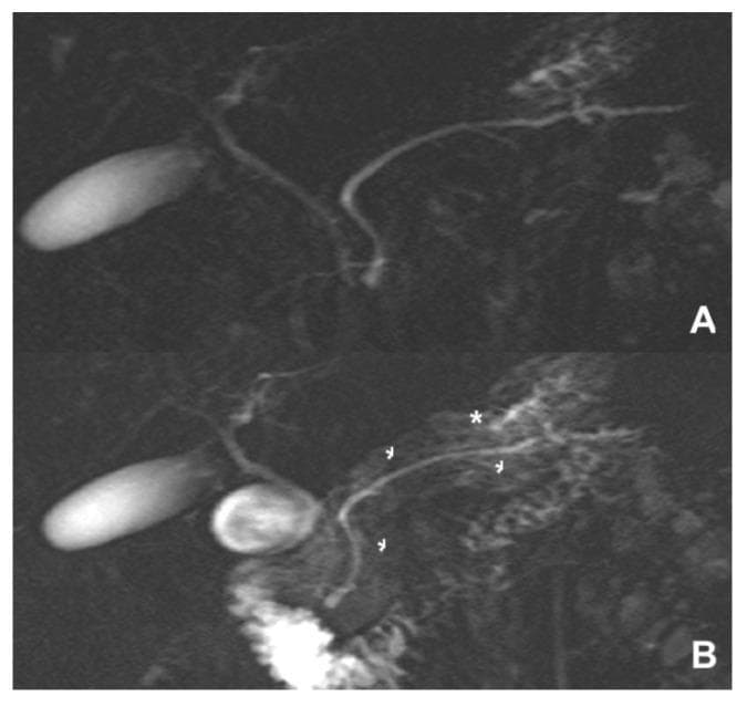 This Comparison Chart consists of two side-by-side (vertical) Diagnostic Images (A and B) showing Magnetic Resonance Cholangiopancreatography (MRCP) findings in a case of Sphincter of Oddi dysfunction (SOD). Image A presents a baseline MRCP where the gallbladder and primary biliary tree are visible, but the pancreatic parenchyma and small ductal side branches are poorly delineated. Image B displays a Secretin-stimulated MRCP (S-MRCP) of the same anatomical region. Key visual features in Image B include diffuse pancreatic parenchymal enhancement (indicated by an asterisk), which appears as a cloud-like increase in signal intensity throughout the gland. Additionally, small arrowheads highlight improved visualization of the Main Pancreatic Duct (MPD) and its side branches due to secretin-induced bicarbonate secretion. The contrast between A and B demonstrates the functional utility of S-MRCP in assessing pancreatic exocrine reserve and identifying subtle abnormalities in ductal dynamics, which are diagnostic indicators for recurrent acute pancreatitis or chronic pancreatitis secondary to SOD.