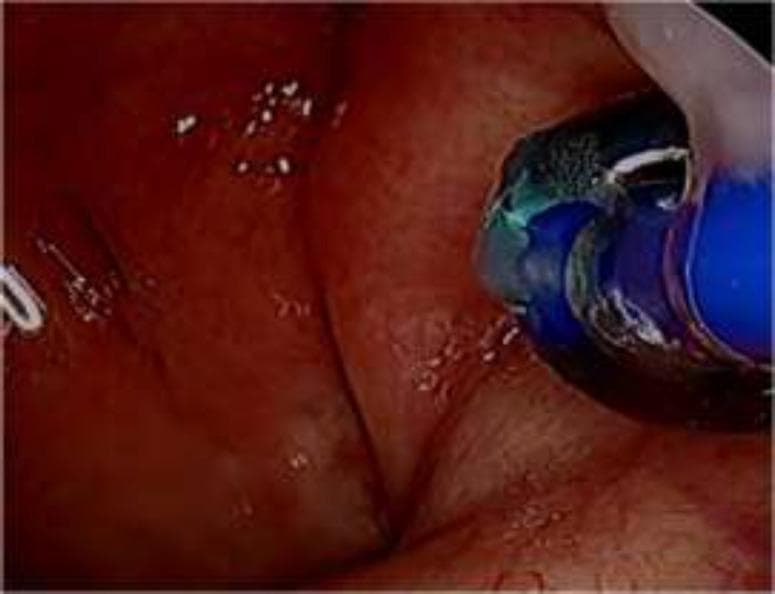 An endoscopic clinical photograph demonstrating a Balloon Eustachian Tuboplasty (BET) procedure within the nasopharynx. The image shows a dark blue, inflated balloon catheter positioned within the pharyngeal orifice of the Eustachian tube. The balloon is inserted into the cartilaginous portion of the tube to perform dilation. The surrounding mucosa appears erythematous and highly vascularized, characteristic of the nasopharyngeal lining. Significant anatomical landmarks include the torus tubarius and the folds of the Eustachian tube opening. The procedure is performed under transnasal endoscopic guidance to alleviate Eustachian tube dysfunction by widening the narrowest portion of the tube. This visual highlights the surgical intervention for middle ear aeration disorders, illustrating the precise placement of the dilation device relative to the surrounding soft tissue structures.