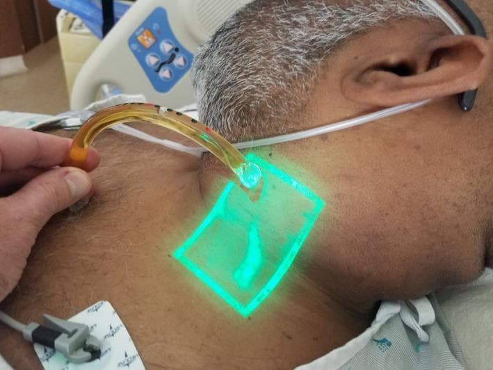 This clinical photograph demonstrates a novel technique for measuring jugular venous pressure (JVP) in a patient with heart failure. The image shows the lateral neck of an adult male where a bedside vein finder emits a rectangular green light to enhance the visualization of the external jugular vein (EJV). Within the illuminated area, the EJV appears as a darker, distended Y-shaped structure. Simultaneously, a clinician is using a 'venous arch' (or jugulometer)—a curved, translucent plastic tube with black and red calibration markings—to measure the vertical height of the venous column. One end of the arch is placed at the level of the sternal angle (not fully visible) while the other aligns with the venous meniscus on the neck. This procedure aims to estimate central venous pressure (CVP) by adding the vertical height measured to the 5 cm distance from the sternal angle to the right atrium. This method is particularly useful in patients where physical assessment of JVP is complicated by obesity or specific body habitus.