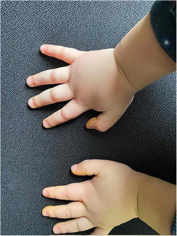 This clinical photograph shows the bilateral hands of a pediatric patient exhibiting significant non-pitting edema. The swelling is most pronounced across the dorsum of the hands, palms, and wrists, causing the skin to appear taut and shiny. The fingers show diffuse enlargement (angioedema) with a loss of normal anatomical definition around the joints. Notably, the skin remains pale and lacks associated erythema, urticaria (hives), or bruising, which are key diagnostic features in distinguishing hereditary angioedema (HAE) from allergic reactions. This image serves as a classic educational representation of peripheral angioedema in a child with HAE Type I, characterized by deep dermal and subcutaneous tissue swelling. The visual evidence illustrates the clinical manifestation of C1 esterase inhibitor deficiency, highlighting the localized, non-inflammatory nature of the edema during an acute attack.