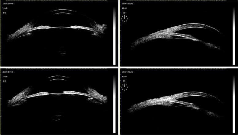 A multi-panel preoperative Ultrasound Biomicroscopy (UBM) image displaying the anterior segment of the right eye (OD, top panels) and left eye (OS, bottom panels) in a patient with chronic angle-closure glaucoma. The high-resolution cross-sectional scans illustrate bilateral anterior chamber angle closure, characterized by the iris root apposition against the trabecular meshwork. Centrally, the anterior chamber depth appears maintained with a regular circular pupillary configuration. The crystalline lens in both eyes is in a normal anatomical position without evidence of subluxation or tilt. Notably, the anterior lens capsule appears smooth, hyperechoic, and continuous, showing no signs of synechiae or adhesions to the posterior iris surface. This imaging study serves as a diagnostic baseline to evaluate ocular anatomy before procedures like Ultrasound Ciliary Plasty (UCP) or cataract surgery, specifically assessing the structural relationships between the iris, ciliary body, and lens equator.