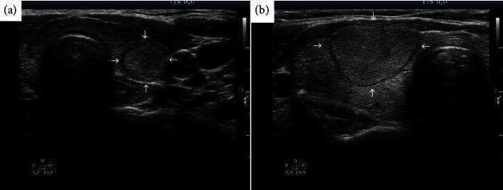 Diagnostic ultrasound comparison showing two distinct presentations of follicular thyroid cancer (FTC). Image (a) depicts a transverse ultrasound view of the thyroid gland containing a small (12 mm), relatively well-defined, circular, mildly hypoechoic nodule indicated by white arrows. This nodule represents a low-suspicion lesion (EU-TIRADS 3), which pathologically was confirmed as minimally invasive follicular cancer. Image (b) shows a significantly larger (28 mm), more heterogeneous, and lobulated nodule (arrows) in the thyroid gland of another patient. The larger mass in (b) represents a progressed case of follicular cancer that had metastasized to the lungs. The comparison illustrates the clinical challenge of diagnosing FTC using standard ultrasound-based Fine Needle Aspiration (FNA) criteria, as early-stage follicular cancers often lack the high-risk sonographic features (such as microcalcifications or irregular margins) seen in papillary thyroid carcinoma, potentially leading to diagnostic delays if triage is based solely on TIRADS size thresholds.