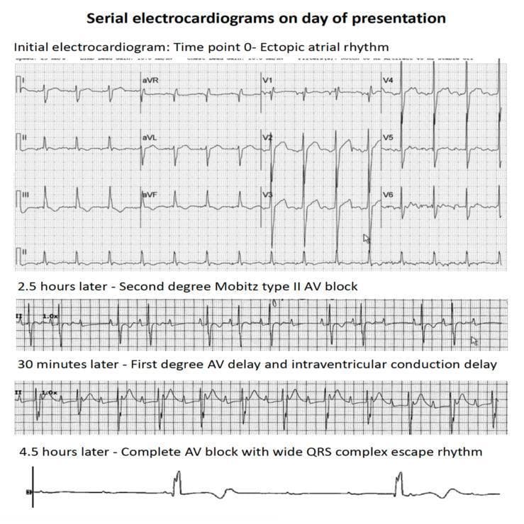 This diagnostic image consists of a series of four electrocardiogram (ECG) rhythm strips demonstrating the rapid clinical progression of atrioventricular (AV) conduction abnormalities over a period of 4.5 hours. The top panel, labeled 'Time point 0', shows an ectopic atrial rhythm with organized P-wave activity and narrow QRS complexes. The second strip, recorded 2.5 hours later, displays a second-degree Mobitz type II AV block, characterized by intermittently dropped QRS complexes without preceding PR interval lengthening. The third strip, 30 minutes later, indicates a first-degree AV delay (prolonged PR interval) and intraventricular conduction delay (widened QRS). The final rhythm strip at 4.5 hours shows third-degree (complete) AV block, characterized by complete AV dissociation and a slow, wide QRS complex ventricular escape rhythm. This progression illustrates acute cardiac conduction system failure, typically associated with myocardial infiltration or severe injury, as seen in patients with leukemic infiltration of the heart.