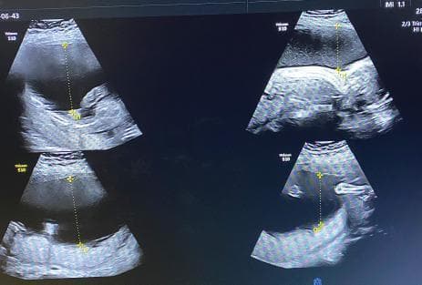 This diagnostic image is an obstetric ultrasound composite displaying four views of the uterus during a twin pregnancy evaluation. The content type is a diagnostic imaging study focusing on amniotic fluid assessment in the context of Twin-to-Twin Transfusion Syndrome (TTTS). The ultrasound shows the recipient twin in a monochorionic diamniotic (MCDA) pregnancy exhibiting severe polyhydramnios. Large, anechoic (black) areas represent significantly increased amniotic fluid volume. Calipers and dotted vertical lines demonstrate the measurement of the Single Deepest Vertical Pocket (SDVP), with the largest pocket exceeding the 8 cm threshold for polyhydramnios. The clinically reported Amniotic Fluid Index (AFI) is approximately 30.9 cm. This visual evidence of excessive liquor volume in one twin, combined with discordant fetal growth, supports a diagnosis of TTTS (Quintero Stage 2). The target audience for this educational material includes radiology and obstetrics students learning to identify ultrasound markers of fetal complications in multiple gestations.