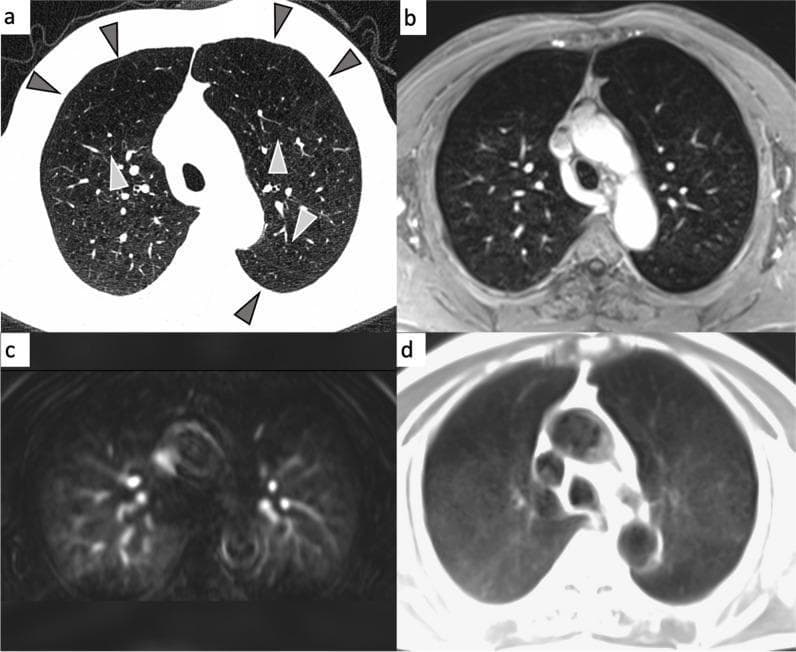 This multi-panel figure presents a comparison of diagnostic imaging modalities—CT and MRI—for evaluating emphysema-predominant Chronic Obstructive Pulmonary Disease (COPD) in a 69-year-old patient. Panel (a) shows a transverse CT scan displaying severe emphysema, characterized by multiple low-attenuation areas (arrowheads) indicating tissue destruction and hyperinflation in both anterior upper lobes and the left lower lobe tip. Panel (b) is a contrast-enhanced transverse 3D T1-weighted gradient echo MRI, where emphysematous regions appear as parenchymal defects with decreased signal intensity. Panel (c) provides a dynamic contrast-enhanced (DCE) perfusion MRI, illustrating perfusion deficits in the affected lobes due to vascular pruning and reduced blood flow. Panel (d) shows a transverse half-Fourier fast spin echo MRI, where diseased areas manifest as signal voids (dark regions). The images collectively demonstrate how emphysema affects lung structure, perfusion, and signal characteristics across radiological modalities, used for phenotyping COPD in clinical research.