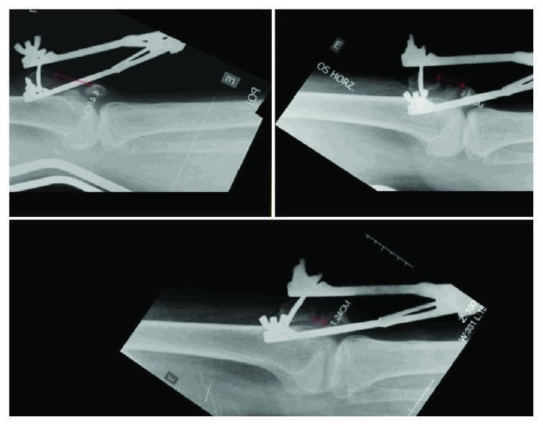 This set of three lateral-view radiological images (X-rays) demonstrates the management of a chronic patellar fracture with significant diastasis and subsequent pseudoarthrosis. The images highlight a transskeletal patellar traction assembly utilizing an external fixation device and a transversely inserted Steinmann pin in the proximal patellar pole. Superimposed red digital measurement lines quantify the distance between the proximal and distal bone fragments, showing a serial reduction in the gap from an initial wide diastasis to 1.24 cm in the final panel. The radiographs capture the knee in extension, illustrating the orthopedic approach to preoperative fracture reduction via progressive traction. Key anatomical structures visible include the femur, tibia, and the distracted patellar fragments. This visual material is highly relevant for orthopedic surgical training, specifically regarding the treatment of neglected patellar fractures and the use of external skeletal traction for soft tissue and bone mobilization.