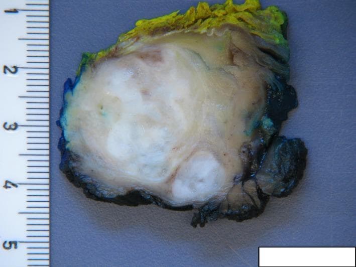This diagnostic clinical photograph displays a gross surgical pathology specimen of an intramuscular myxoma. The image shows a cross-section of a well-circumscribed, roughly oval soft tissue mass measuring approximately 4-5 cm in diameter, as indicated by an adjacent metric ruler. The tumor exhibits a characteristic zonal architecture: a central, semi-translucent, glistening white region with a gelatinous or myxoid consistency and subtle swirling patterns, surrounded by a peripheral rim of denser, tan-to-yellowish solid tissue. The external margins of the specimen are marked with surgical inks (black, blue, and yellow) used for surgical orientation and margin assessment. The macroscopic appearance is consistent with a benign myxomatous lesion, often found within large skeletal muscles such as the deltoid. This visual is an essential educational resource for distinguishing benign myxoid tumors from more aggressive mimics like low-grade fibromyxoid sarcoma in orthopedic oncology.