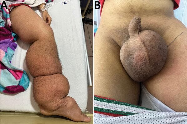 Two-panel clinical photograph illustrating the manifestations of lymphatic filariasis (elephantiasis) caused by Wuchereria bancrofti. Image A displays a side profile of the left lower limb exhibiting severe, generalized lymphedema from the foot to the groin. There is significant swelling and skin folds, erythematous patches on the thigh, and trophic skin changes including perimaleolar hypocromia and hypercromia. Image B provides a frontal view of the pelvic region, showing massive, bulbous scrotal edema (hydrocele) and induration. The skin of the scrotum appears thickened and tense. These findings are characteristic of chronic lymphatic obstruction leading to massive tissue enlargement and secondary dermatological changes. The images are highly relevant for tropical medicine and infectious disease specialties, demonstrating the late-stage physical sequelae of nematode-induced lymphatic damage.