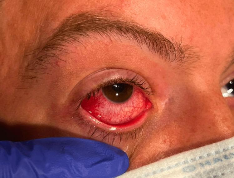 This clinical photograph shows a close-up of a patient's right eye during a medical examination, illustrating significant conjunctival and scleral injection. The primary finding is marked diffuse erythema over the bulbar conjunctiva, characterized by engorged and prominent blood vessels across the scleral surface. The intensity of the vascular injection is most pronounced at the medial canthus (inner corner) and the inferior aspect of the globe. The cornea remains relatively clear with visible iris details, and there is no obvious purulent discharge, suggesting an inflammatory rather than infectious etiology. Surrounding structures, including the eyebrow, eyelashes, and skin tone, appear normal. The lower portion of the frame shows an examiner's gloved hand and surgical mask, providing clinical context. This visual is representative of ocular manifestations associated with systemic inflammatory conditions, such as the extraintestinal manifestations seen in Crohn's disease or other forms of episcleritis/uveitis.