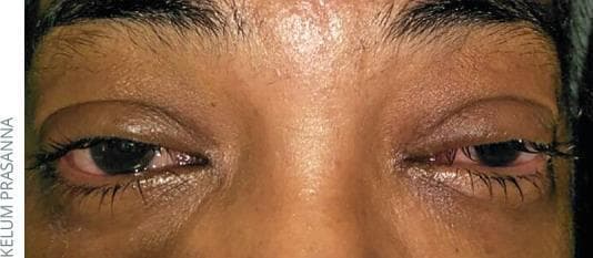 This clinical photograph shows a close-up frontal view of a patient's eyes exhibiting hallmark signs of viral conjunctivitis. Bilateral conjunctival injection is evident, characterized by diffuse redness and prominent vascularization across the bulbar and palpebral sclera, particularly concentrated in the inferior regions. There is visible eyelid edema (chemosis) resulting in a slightly swollen or puffy appearance of the periorbital tissues. The eyes demonstrate increased lacrimation or watery discharge, giving the lid margins a glistening, moist texture. The periocular skin appears hyperpigmented and somewhat shiny compared to the forehead, likely secondary to chronic irritation or fluid accumulation. The primary clinical focus is on identifying acute inflammatory changes of the ocular surface, including hyperemia and epiphora, which are typical manifestations of a viral infection such as adenovirus. This image serves as an educational reference for distinguishing viral etiologies from bacterial or allergic conjunctivitis based on the nature of the discharge and the pattern of inflammation.