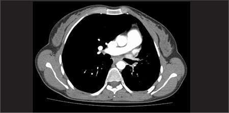 This diagnostic image is an axial cross-section from a Computed Tomography (CT) scan of the human chest, at the level of the mid-thorax. The image demonstrates a transverse view of the mediastinum and pulmonary parenchyma. Key anatomical structures visible include the thoracic vertebral body located posteriorly, the sternum anteriorly, and the rib cage forming the lateral boundaries. Centrally, the mediastinum contains high-density (bright) vascular structures consistent with the heart and great vessels, including the ascending and descending aorta. The bilateral lungs appear as low-density (dark), air-filled regions flanking the central mediastinal structures. No gross masses, significant pleural effusions, or lobar consolidations are immediately apparent in this single slice. This imaging modality is used in clinical medicine to evaluate thoracic anatomy, assess pulmonary disease, and, when combined with functional imaging like SPECT, localize radiopharmaceutical tracer activity within specific anatomical compartments such as the ileal lumen or renal systems.
