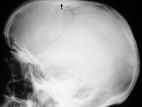 This lateral skull radiograph (X-ray) demonstrates significant skeletal abnormalities. The primary finding is a generalized, marked thickening and sclerosis of the skull vault (calvarium). An arrow highlights a specific area of prominent cortical thickening along the superior aspect of the cranium. The overall bone density is significantly increased, resulting in a more opaque appearance of the cranial bones compared to normal standards. The posterior aspect of the skull appears flattened, consistent with brachycephaly. Additionally, convolutional markings are somewhat obscured by the diffuse sclerosis. These radiographic features are characteristic of generalized sclerosing bone dysplasias, such as osteopetrosis or endosteal hyperostosis syndromes. The image provides clinical evidence for diagnosing metabolic or genetic bone disorders affecting cranial development and mineralization.