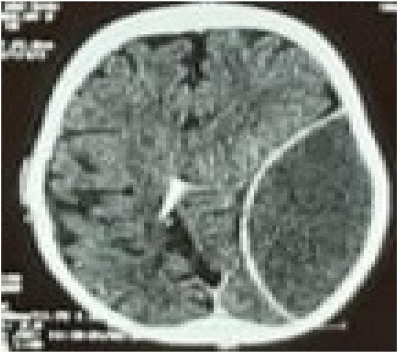 An axial non-contrast CT scan of the brain demonstrating a large, acute epidural (extradural) hematoma in the left hemisphere. The hematoma presents as a well-defined, biconvex (lenticular), hyperdense collection located between the skull and the dura mater. There is a significant mass effect evidenced by the compression of the left cerebral parenchyma, effacement of the adjacent cortical sulci, and midline shift toward the right. In the contralateral hemisphere, a radiopaque ventricular catheter is visible, extending into the posterior aspect of the right lateral ventricle near the occipital horn. This diagnostic image is representative of neurosurgical trauma emergencies, illustrating the classic appearance of arterial bleeding (typically from the middle meningeal artery) and secondary intracranial hypertension markers. The image serves as an educational resource for identifying acute traumatic intracranial hemorrhage and the presence of neurosurgical shunting devices.