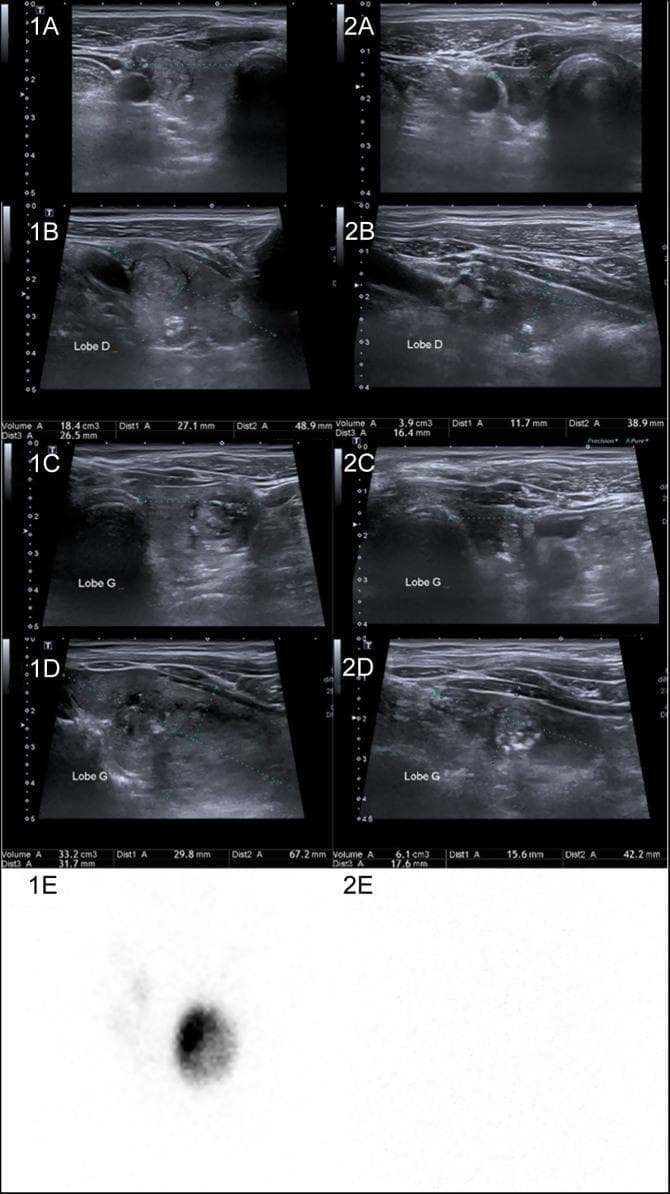 A comparison of thyroid ultrasound (US) and Iodine-123 (123I) scintigraphy before and after immune checkpoint inhibitor (ICI) therapy for melanoma. The pre-therapy images (1a–1d) show a multinodular goiter (MNG) with a right lobe volume of 18.4 mL containing three nodules and a left lobe volume of 33.2 mL with two nodules. Scintigraphy (1e) indicates a hyperfunctioning 'hot' nodule in the left lobe with suppressed uptake in the surrounding parenchyma. Post-therapy images (2a–2d), taken 7 months after ICI initiation, demonstrate significant thyroid atrophy: the right lobe volume decreased to 3.9 mL (nodules disappeared, leaving a macrocalcification) and the left lobe to 6.1 mL (one remaining reduced-size nodule). Follow-up scintigraphy (2e) shows a complete absence of 123I uptake. This visual progression illustrates ICI-induced destructive thyroiditis leading to marked parenchymal atrophy, regression of pre-existing nodules, and evolution from hyperthyroidism to hypothyroidism.