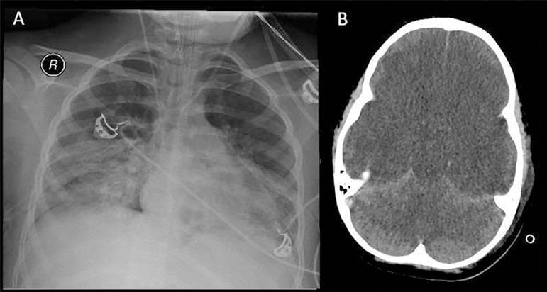 This composite clinical imaging figure illustrates critical multi-organ involvement in a pediatric patient with septic shock.
Panel A is an anteroposterior chest radiograph showing diffuse, bilateral pulmonary infiltrates. The lung fields exhibit extensive hazy opacities that obscure normal vascular markings, consistent with Acute Respiratory Distress Syndrome (ARDS). Medical support devices, including an endotracheal tube and ECG leads, are visible.
Panel B is an axial non-contrast brain computed tomography (CT) scan demonstrating severe, diffuse cerebral edema. Key diagnostic features include the loss of normal gray-white matter differentiation and significant effacement of the cerebral sulci and ventricular system. These findings indicate global hypoxic-ischemic injury and increased intracranial pressure.
Together, the images provide a visual representation of the systemic complications of severe sepsis and hypoxemia, frequently encountered in critical care medicine and neurology when assessing for brain death.