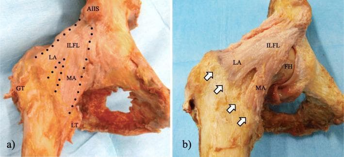 This clinical photograph displays two cadaveric dissections (labeled a and b) of the anterior aspect of a human hip joint, specifically highlighting the anatomy of the iliofemoral ligament (ILFL), also known as the Y-ligament of Bigelow. In panel (a), the ILFL is outlined by a black dotted line, demonstrating its proximal attachment near the anterior inferior iliac spine (AIIS). The ligament bifurcates into two distinct bundles: the lateral arm (LA), which extends toward the greater trochanter (GT), and the medial arm (MA), which descends toward the lesser trochanter (LT). Panel (b) shows the deep capsular anatomy after the removal of superficial fibers and the pubofemoral ligament. White arrows indicate the intertrochanteric line, identifying the distal footprints where the LA and MA insert into the femur. The femoral head (FH) is partially visible beneath the capsular structures. These images are utilized to teach the gross anatomy and surgical landmarks of the hip’s capsular reinforcement system, relevant for orthopedic surgery and physical therapy education.
