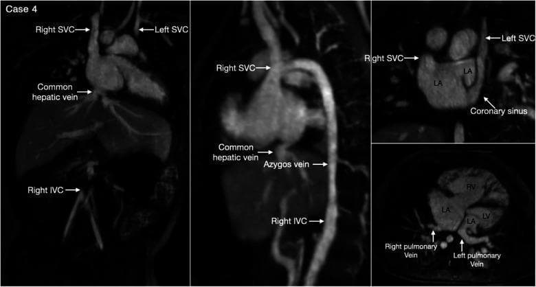 This diagnostic multi-panel image presents contrast-enhanced computerized tomography (CT) and volume-rendered reconstructions of a patient with heterotaxy syndrome and left isomerism. The vascular anatomy demonstrates bilateral superior venae cavae (SVC) without a bridging vein; the left SVC is shown draining into a coronary sinus that empties into the right-sided left atrium (LA). A significant finding is an interrupted inferior vena cava (IVC) with azygos continuation, where the right-sided IVC continues superiorly via the azygos vein to the right-sided SVC. The common hepatic vein is also visualized draining independently. Intracardiac findings include a large atrial septal defect (ASD) in the superior portion of the septum and evidence of myocardial noncompaction in the left ventricle (LV). The pulmonary venous anatomy shows right and left pulmonary veins connecting to the posterior wall of the ipsilateral left atrium. These complex cardiovascular malformations are characteristic of isomerism of the left atrial appendages, illustrating critical diagnostic markers for surgical planning and systemic-to-pulmonary venous separation.